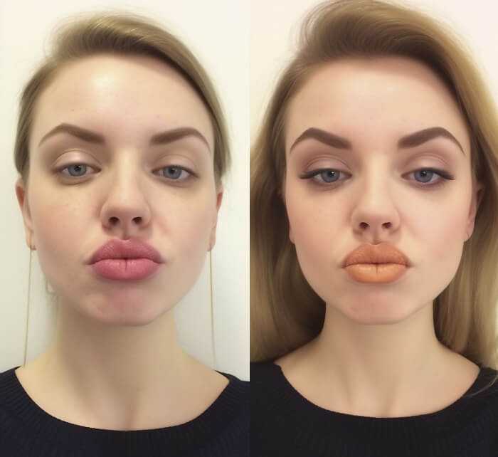 Botox Lip Flip Gone Wrong